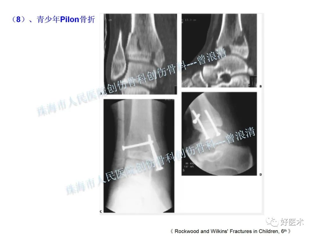 纯高清图谱讲解儿童踝关节骨折，99%的人都能看懂！