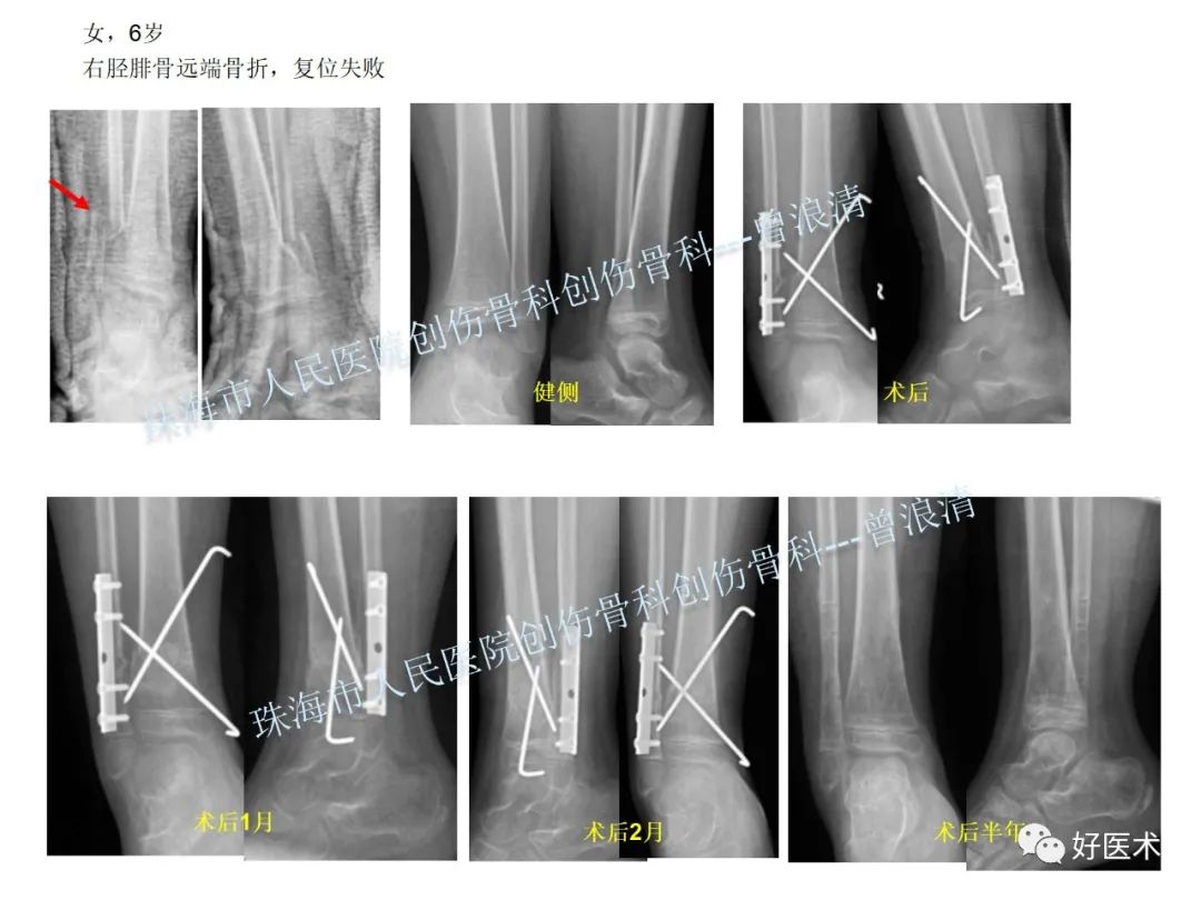 纯高清图谱讲解儿童踝关节骨折，99%的人都能看懂！