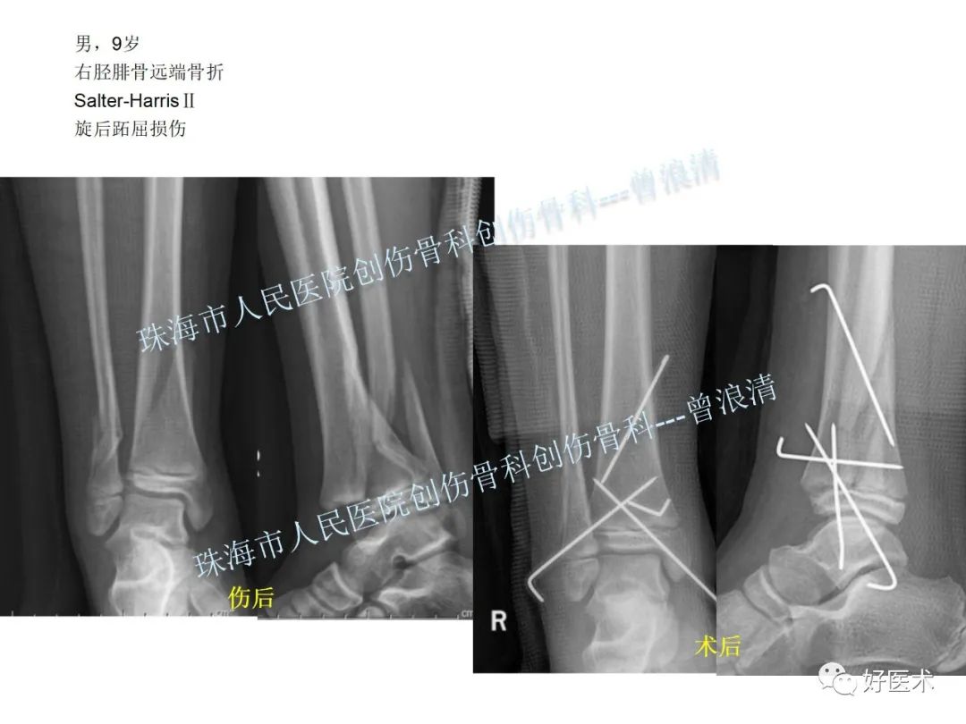 纯高清图谱讲解儿童踝关节骨折，99%的人都能看懂！