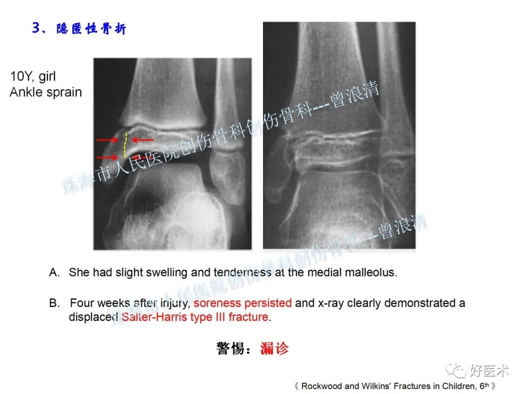 小孩脚踝骨突出的图片,儿童正常的脚踝骨图片(2) - 伤感说说吧