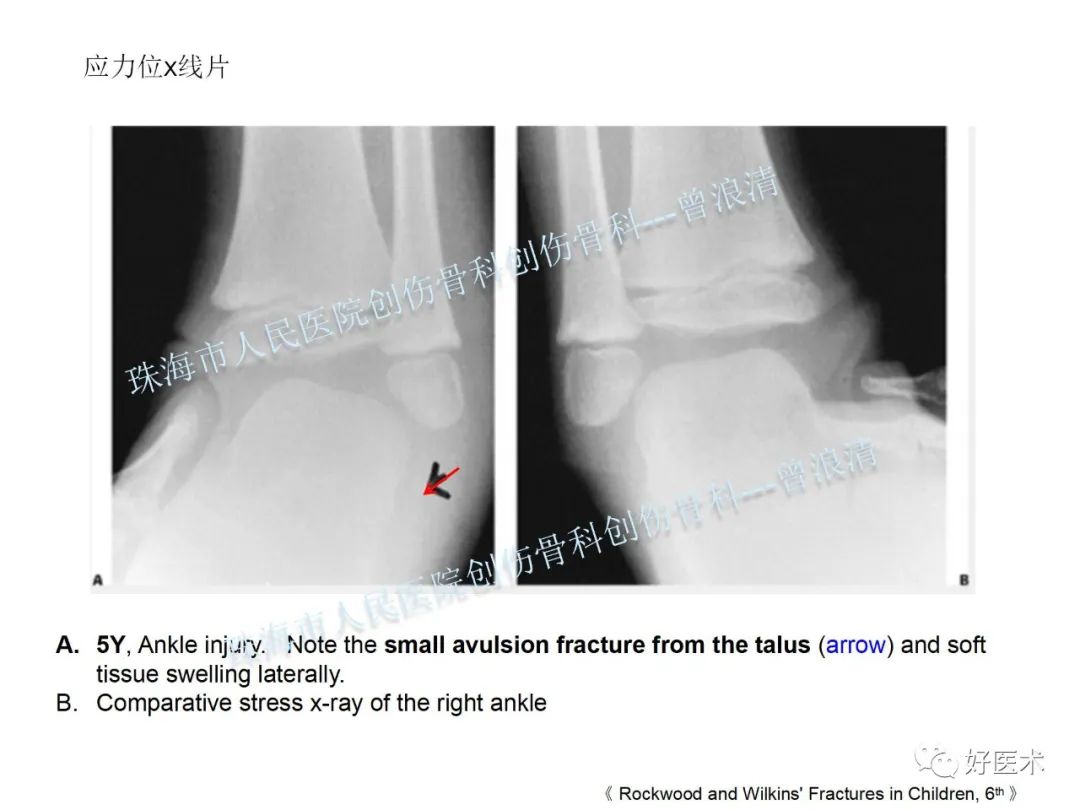 纯高清图谱讲解儿童踝关节骨折，99%的人都能看懂！