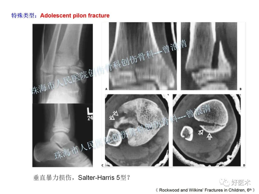 纯高清图谱讲解儿童踝关节骨折，99%的人都能看懂！