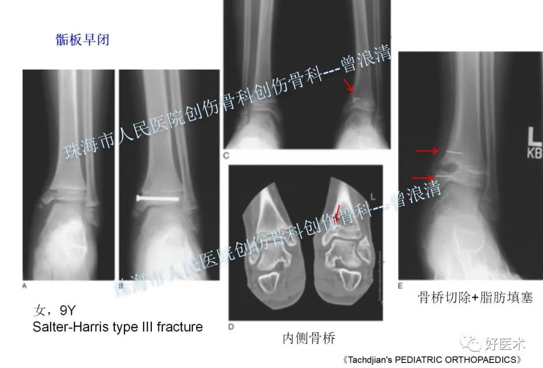 纯高清图谱讲解儿童踝关节骨折，99%的人都能看懂！