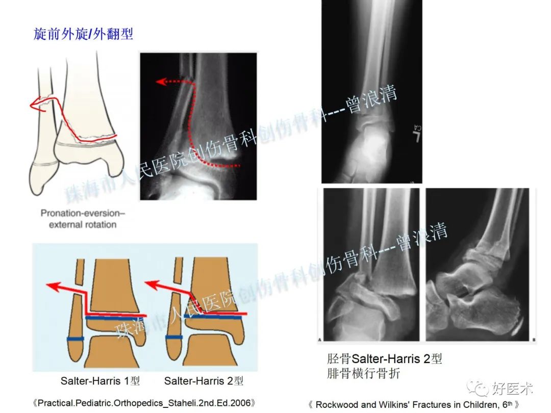 纯高清图谱讲解儿童踝关节骨折，99%的人都能看懂！