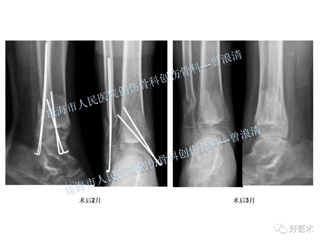 纯高清图谱讲解儿童踝关节骨折，99%的人都能看懂！