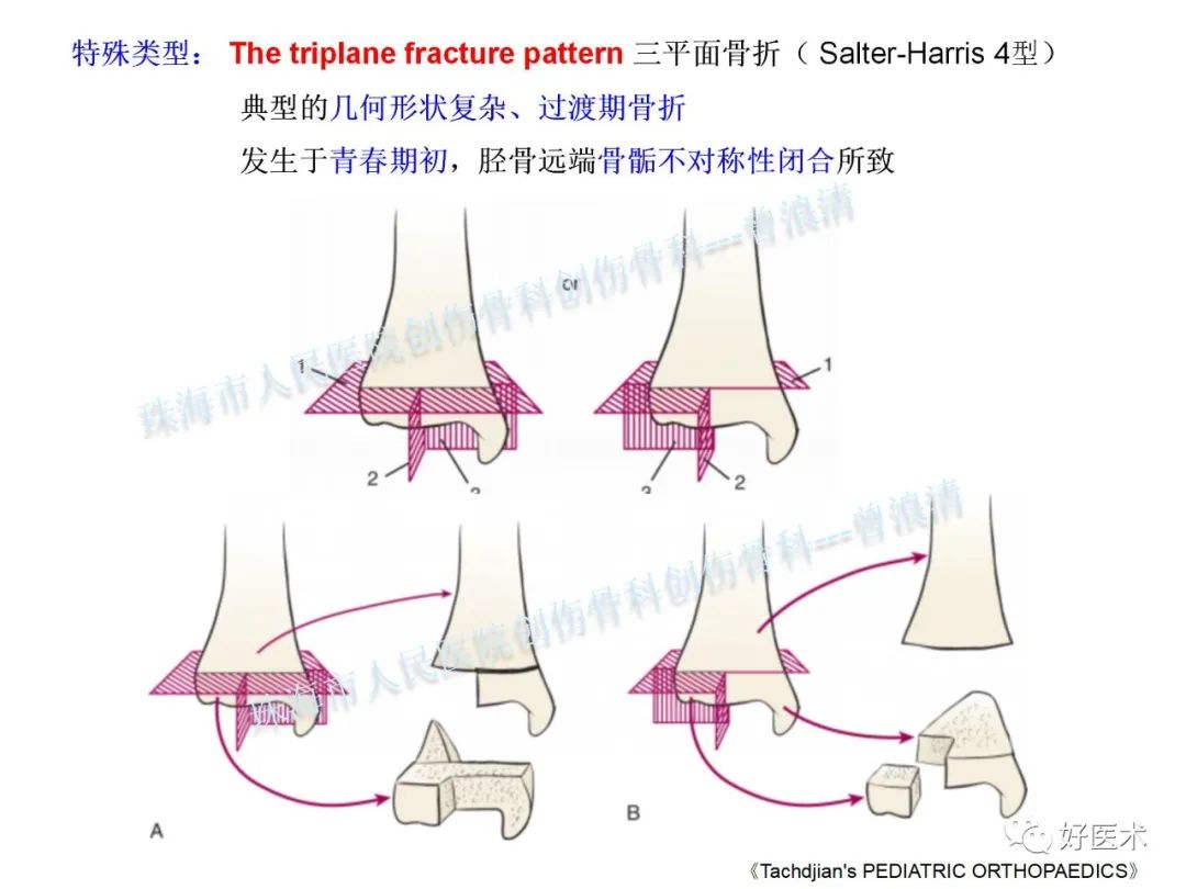 纯高清图谱讲解儿童踝关节骨折，99%的人都能看懂！