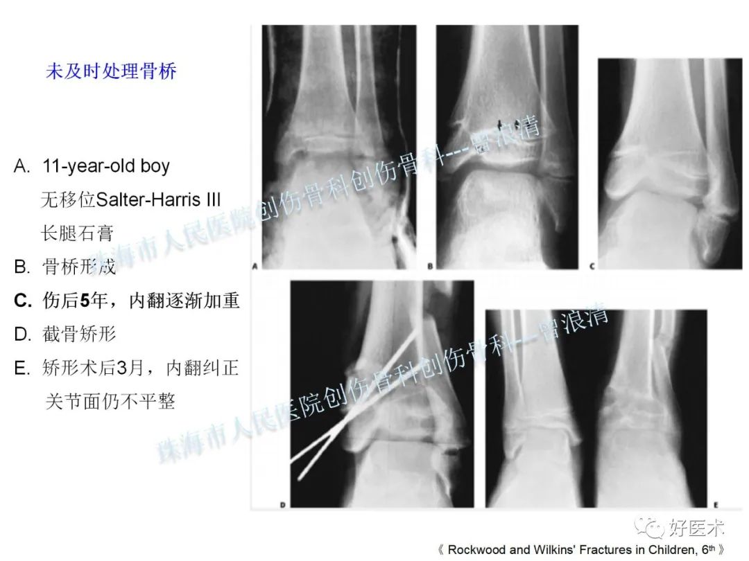 纯高清图谱讲解儿童踝关节骨折，99%的人都能看懂！