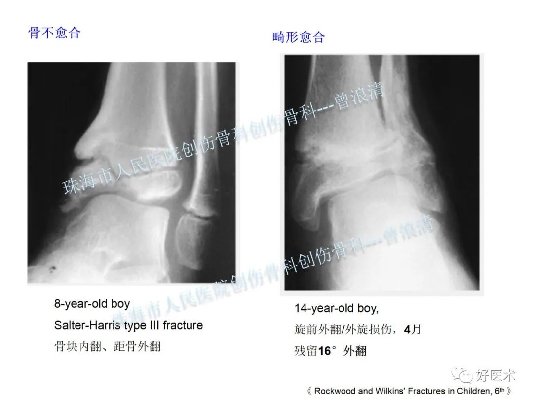 纯高清图谱讲解儿童踝关节骨折，99%的人都能看懂！