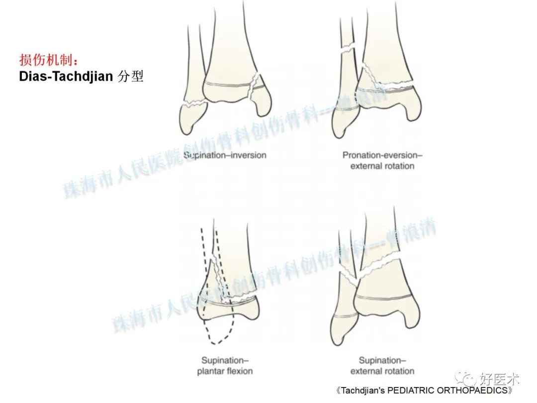 纯高清图谱讲解儿童踝关节骨折，99%的人都能看懂！
