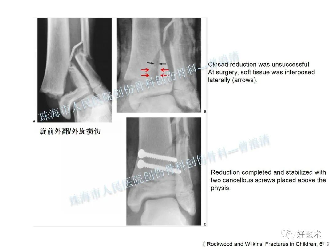纯高清图谱讲解儿童踝关节骨折，99%的人都能看懂！
