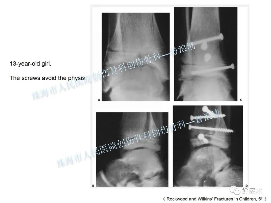 纯高清图谱讲解儿童踝关节骨折，99%的人都能看懂！