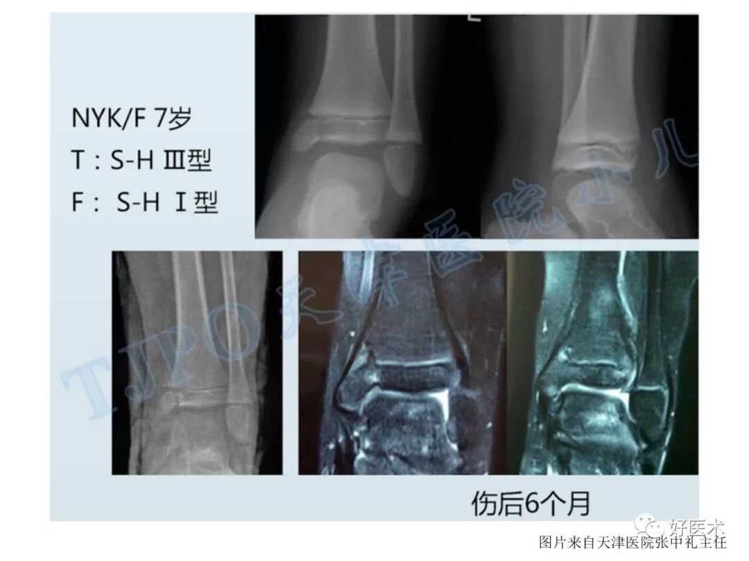 纯高清图谱讲解儿童踝关节骨折，99%的人都能看懂！