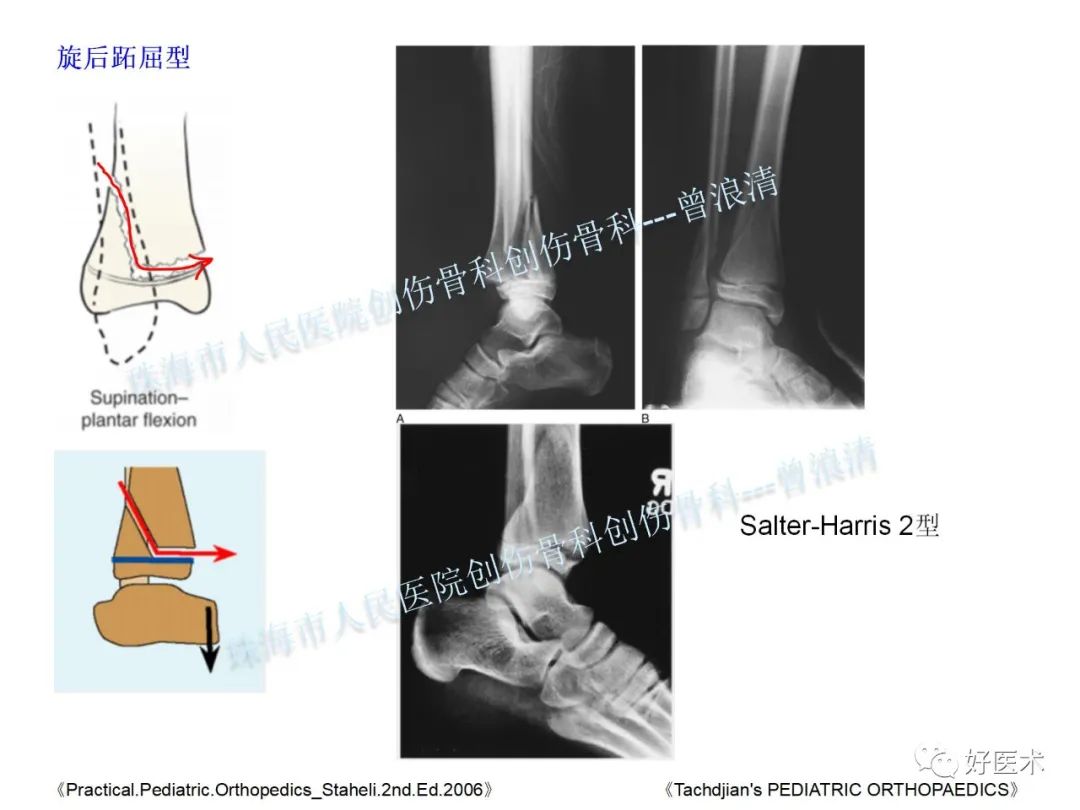 纯高清图谱讲解儿童踝关节骨折，99%的人都能看懂！