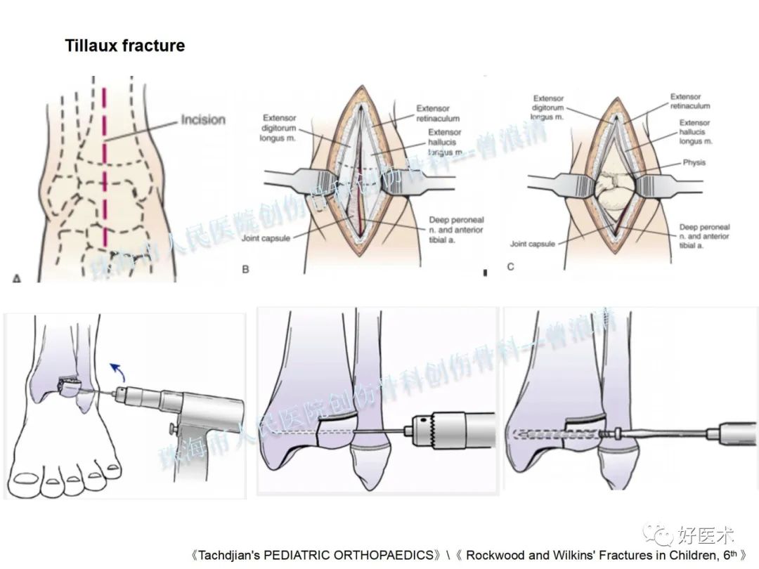 纯高清图谱讲解儿童踝关节骨折，99%的人都能看懂！