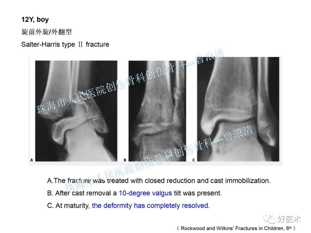 纯高清图谱讲解儿童踝关节骨折，99%的人都能看懂！