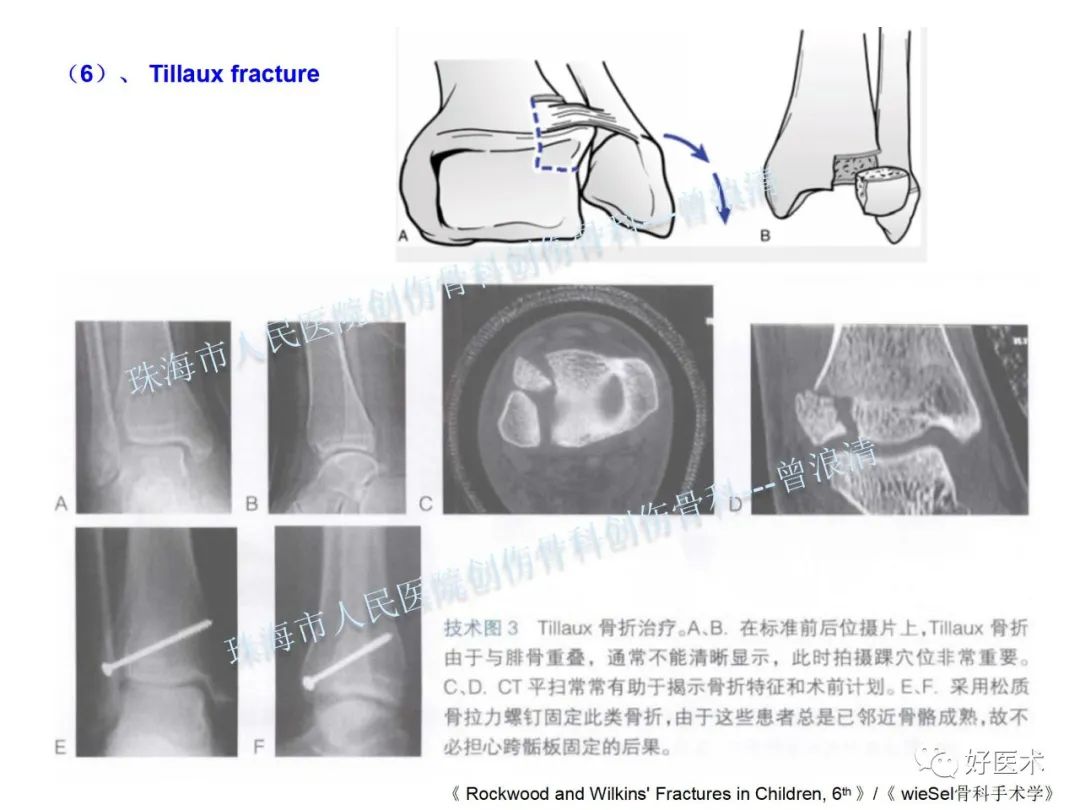 纯高清图谱讲解儿童踝关节骨折，99%的人都能看懂！