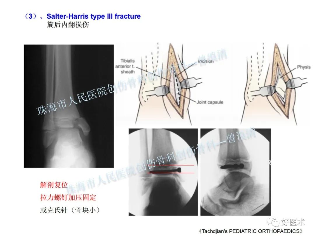 纯高清图谱讲解儿童踝关节骨折，99%的人都能看懂！