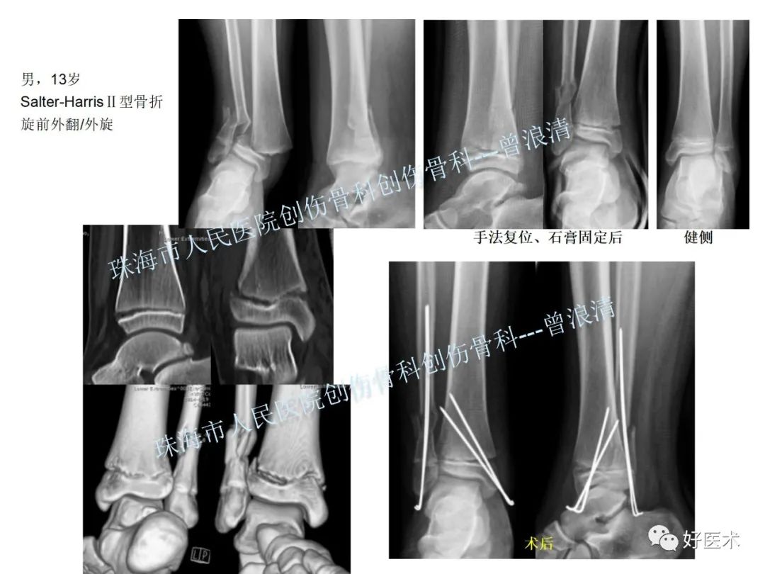 纯高清图谱讲解儿童踝关节骨折，99%的人都能看懂！