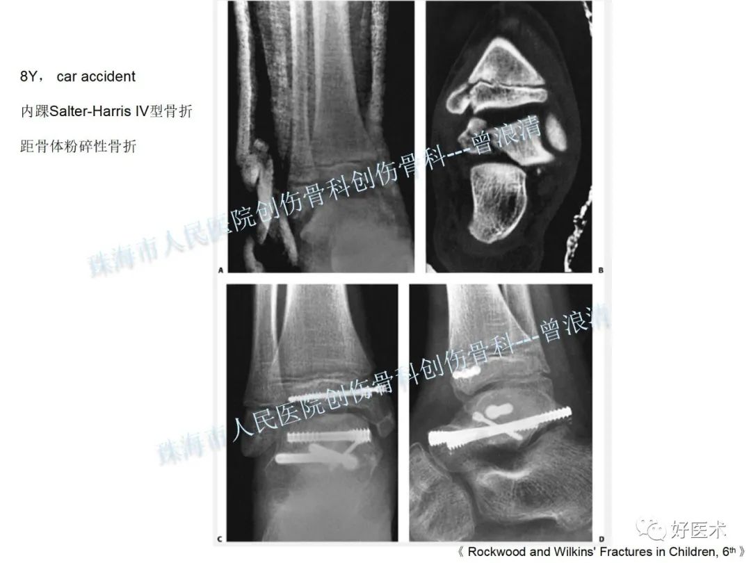 纯高清图谱讲解儿童踝关节骨折，99%的人都能看懂！