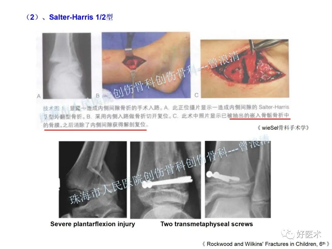 纯高清图谱讲解儿童踝关节骨折，99%的人都能看懂！