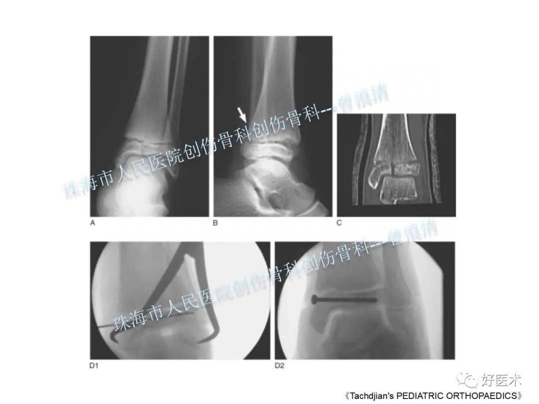 纯高清图谱讲解儿童踝关节骨折，99%的人都能看懂！