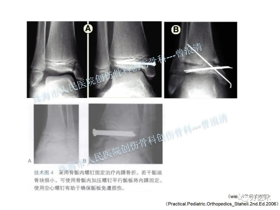 纯高清图谱讲解儿童踝关节骨折，99%的人都能看懂！