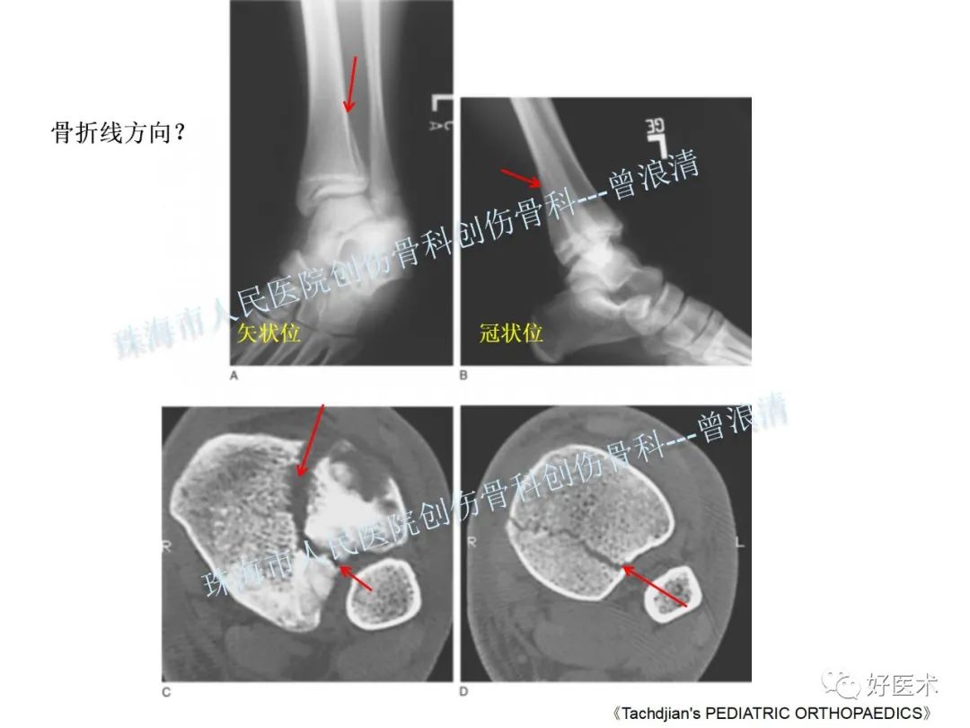 纯高清图谱讲解儿童踝关节骨折，99%的人都能看懂！