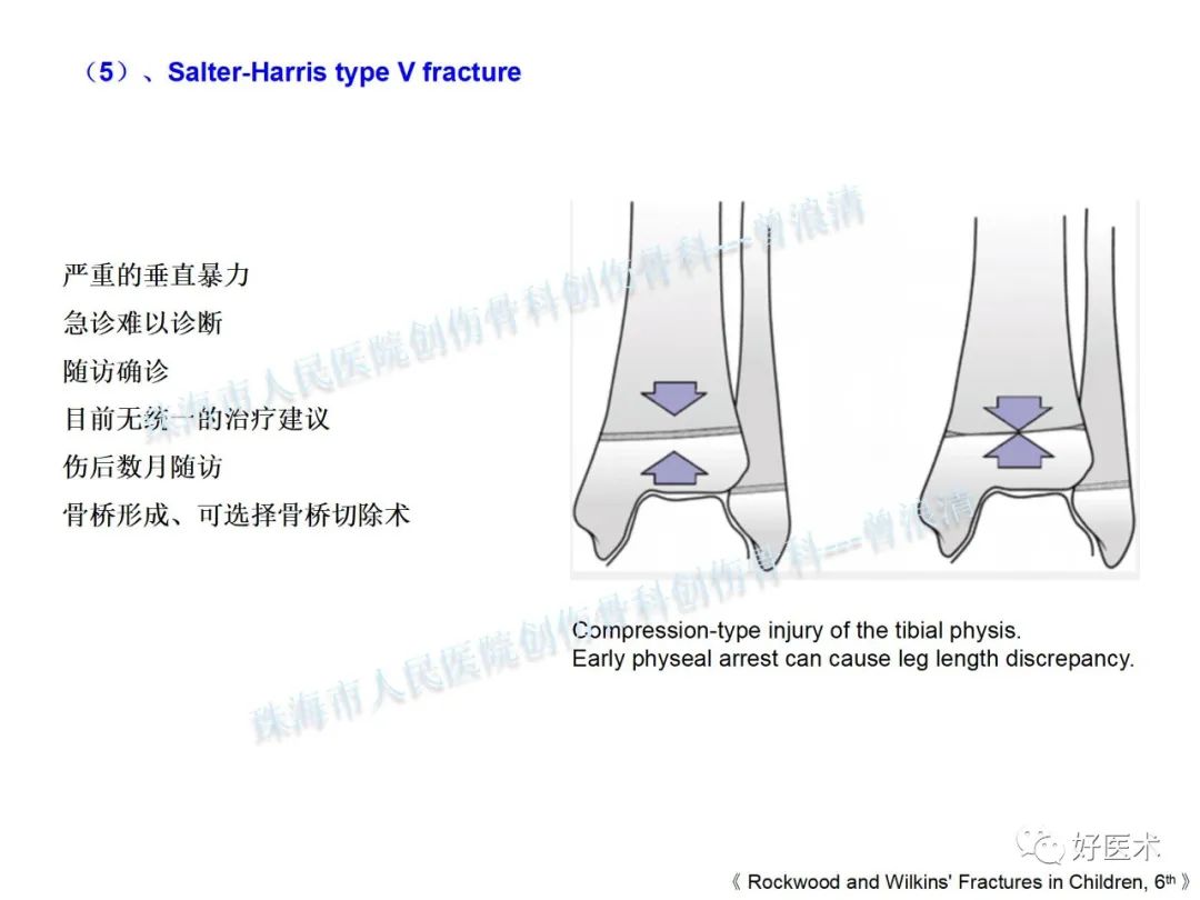 纯高清图谱讲解儿童踝关节骨折，99%的人都能看懂！