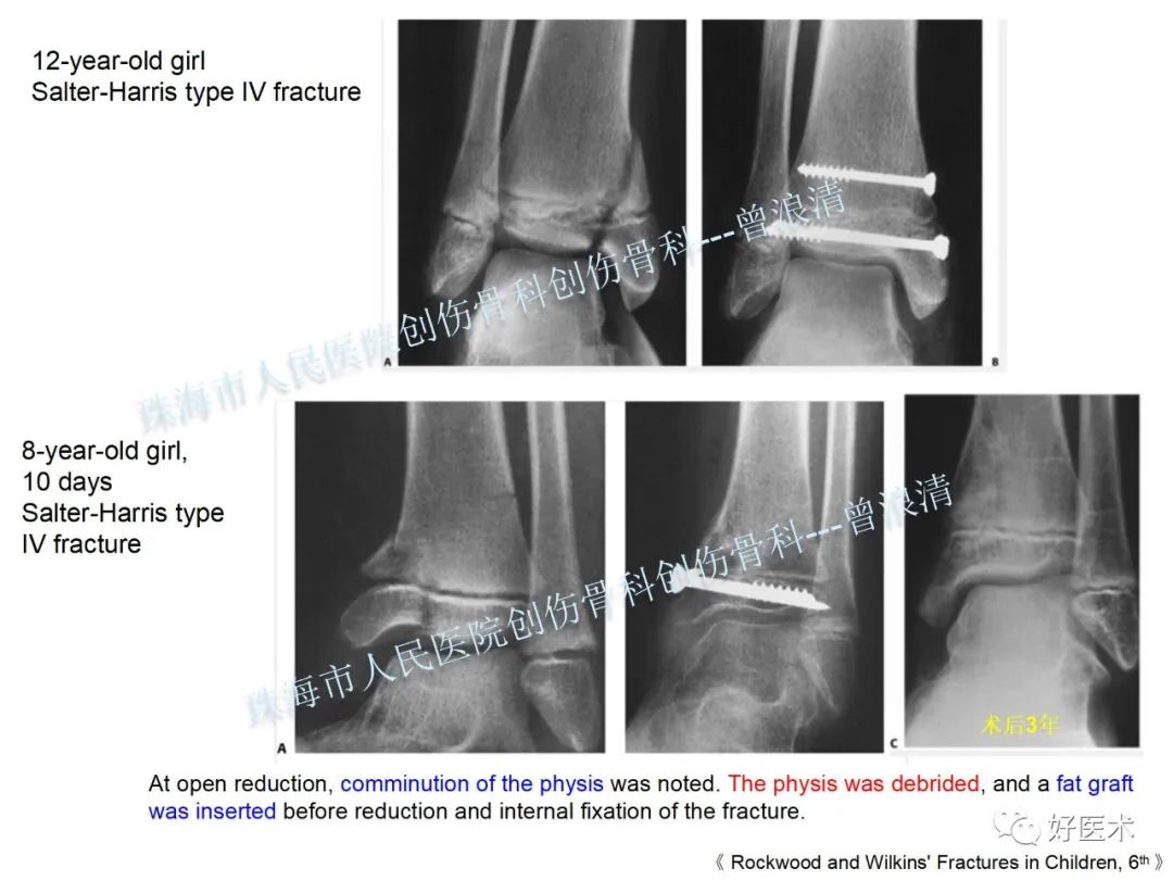 纯高清图谱讲解儿童踝关节骨折，99%的人都能看懂！