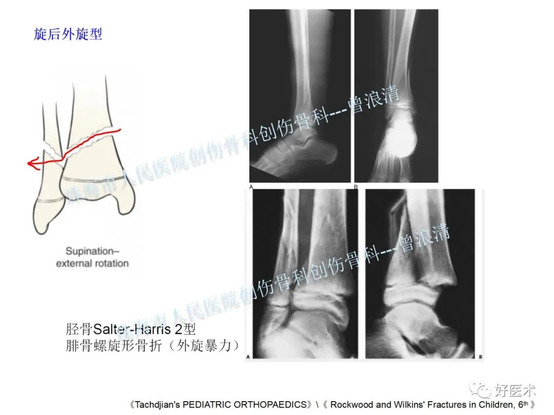 纯高清图谱讲解儿童踝关节骨折，99%的人都能看懂！