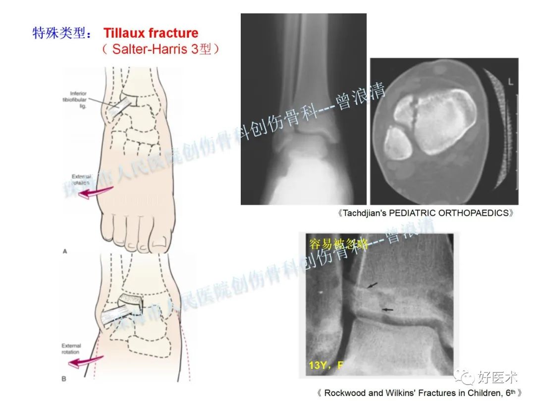 纯高清图谱讲解儿童踝关节骨折，99%的人都能看懂！