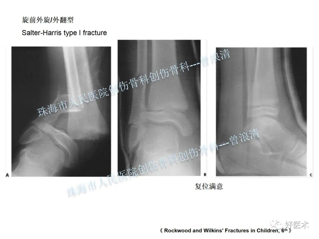 纯高清图谱讲解儿童踝关节骨折，99%的人都能看懂！
