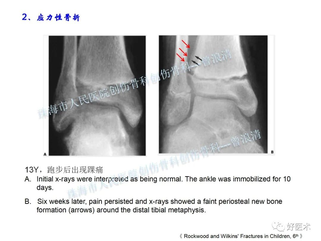 纯高清图谱讲解儿童踝关节骨折，99%的人都能看懂！