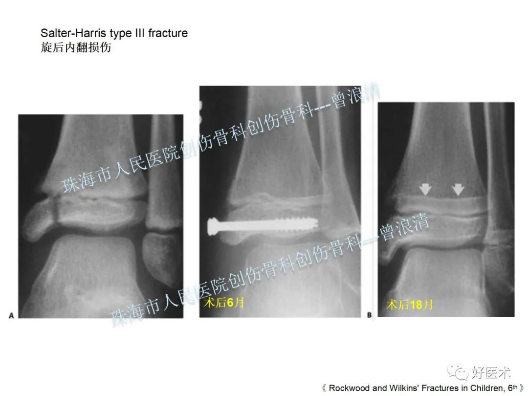 纯高清图谱讲解儿童踝关节骨折，99%的人都能看懂！