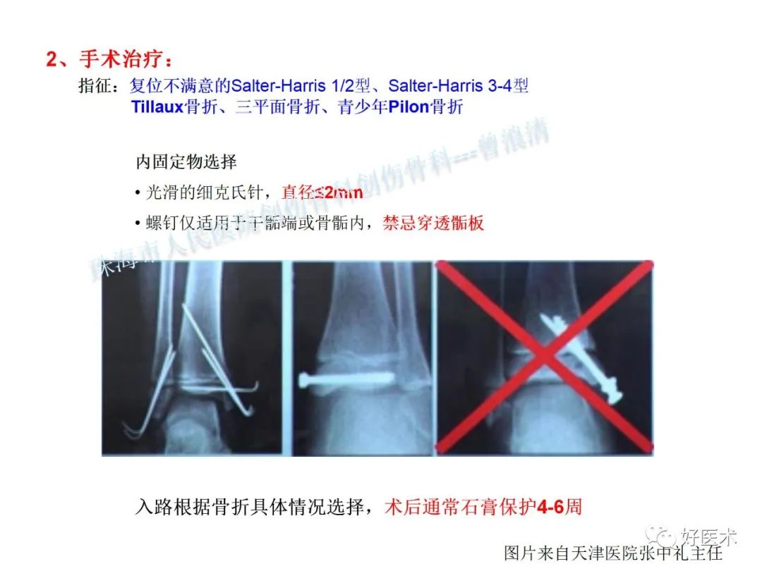 纯高清图谱讲解儿童踝关节骨折，99%的人都能看懂！