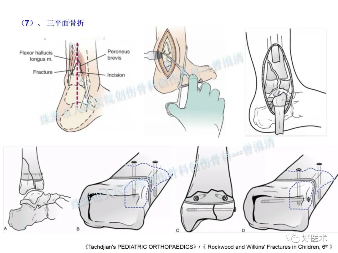 纯高清图谱讲解儿童踝关节骨折，99%的人都能看懂！