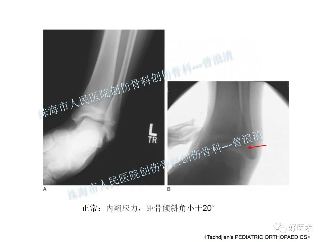 纯高清图谱讲解儿童踝关节骨折，99%的人都能看懂！