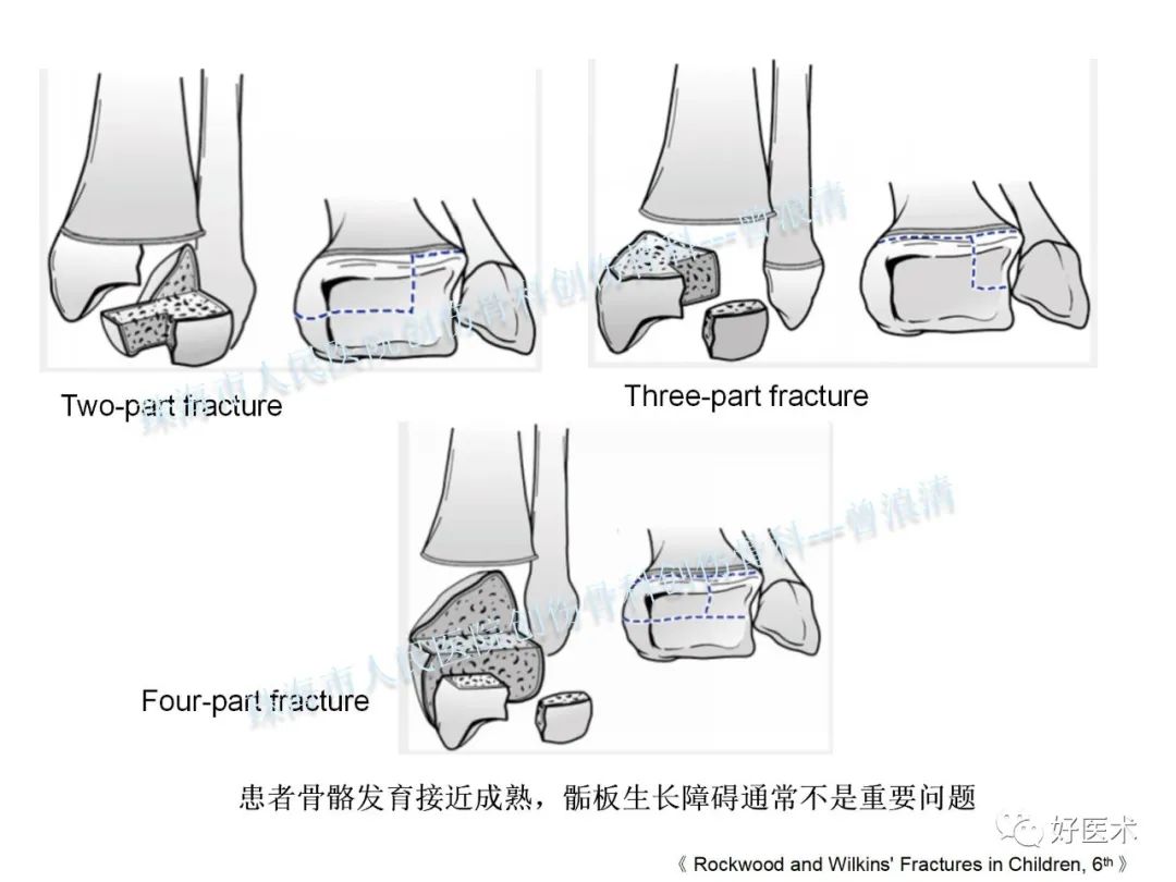 纯高清图谱讲解儿童踝关节骨折，99%的人都能看懂！