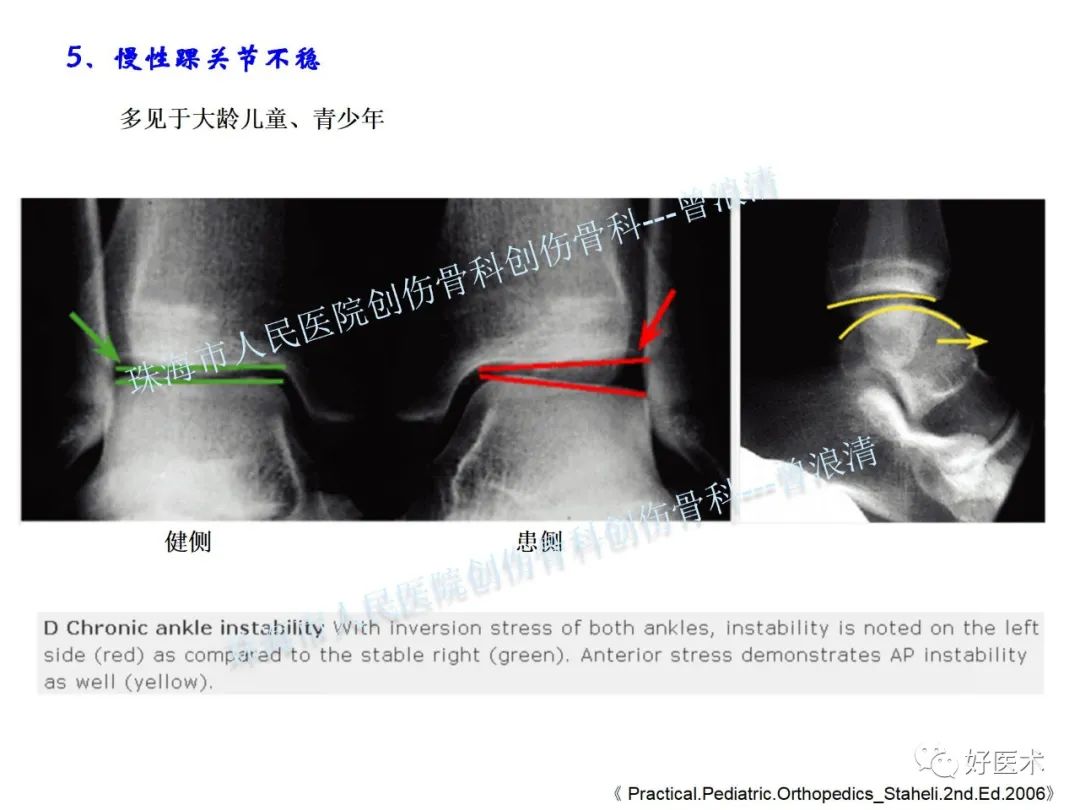 纯高清图谱讲解儿童踝关节骨折，99%的人都能看懂！