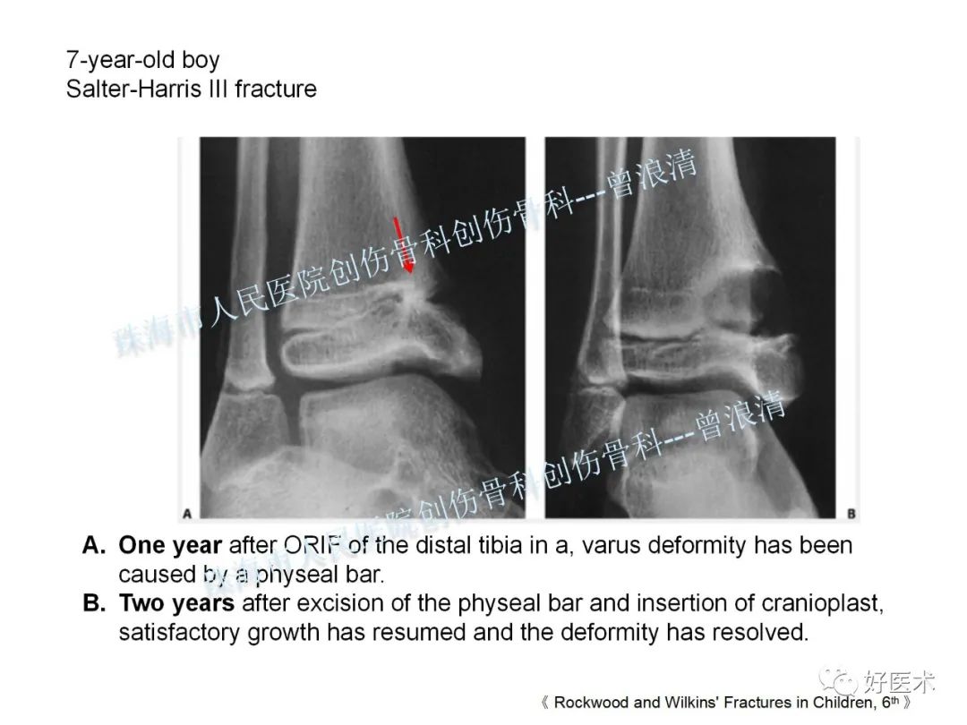 纯高清图谱讲解儿童踝关节骨折，99%的人都能看懂！