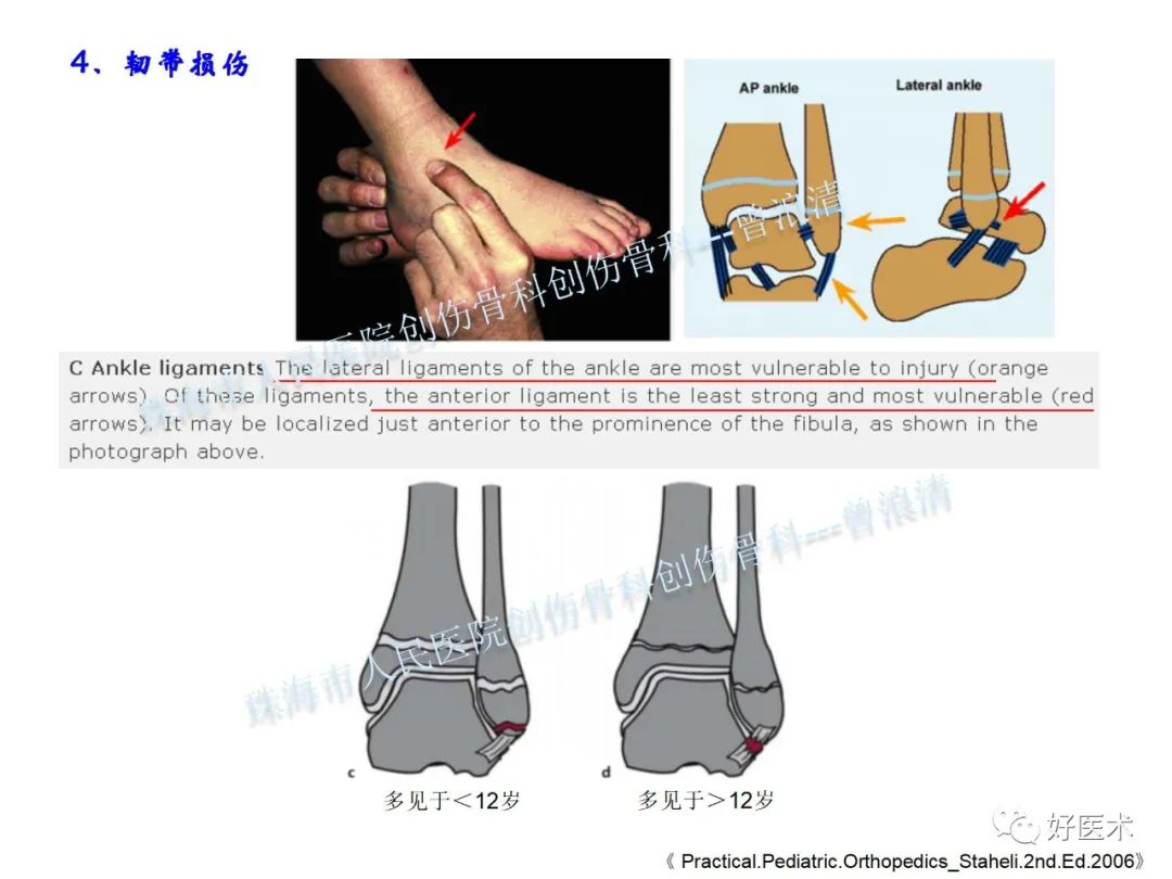 纯高清图谱讲解儿童踝关节骨折，99%的人都能看懂！