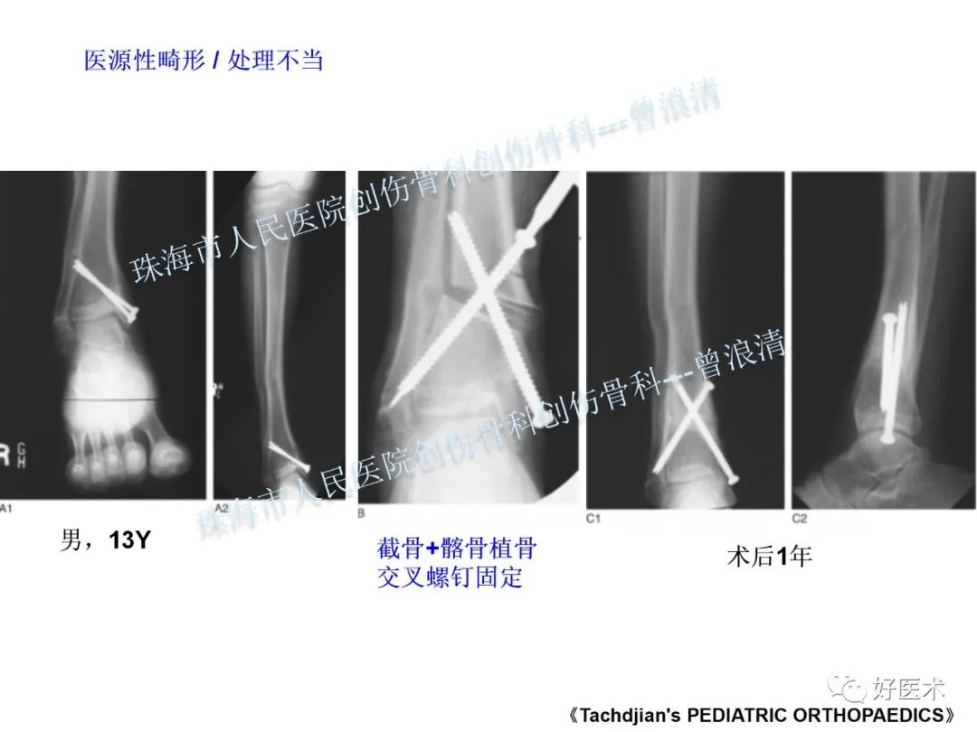 纯高清图谱讲解儿童踝关节骨折，99%的人都能看懂！