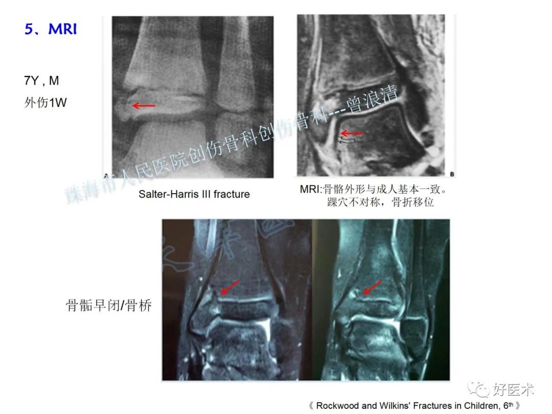 纯高清图谱讲解儿童踝关节骨折，99%的人都能看懂！