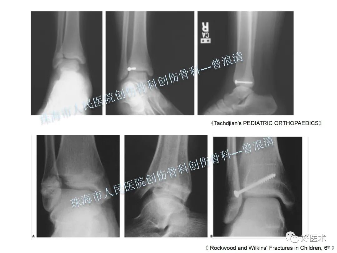纯高清图谱讲解儿童踝关节骨折，99%的人都能看懂！