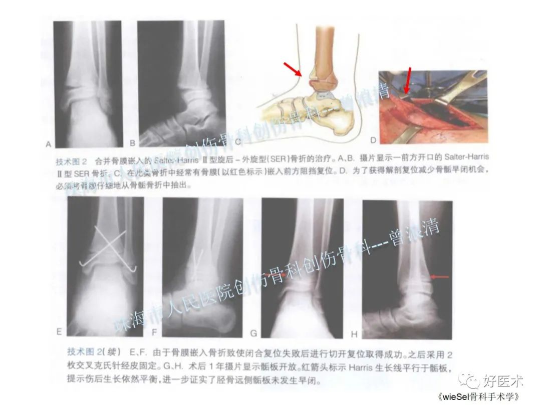 纯高清图谱讲解儿童踝关节骨折，99%的人都能看懂！