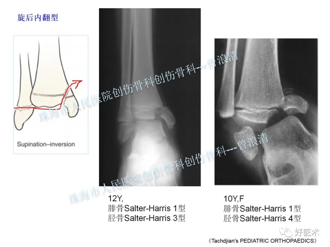 纯高清图谱讲解儿童踝关节骨折，99%的人都能看懂！