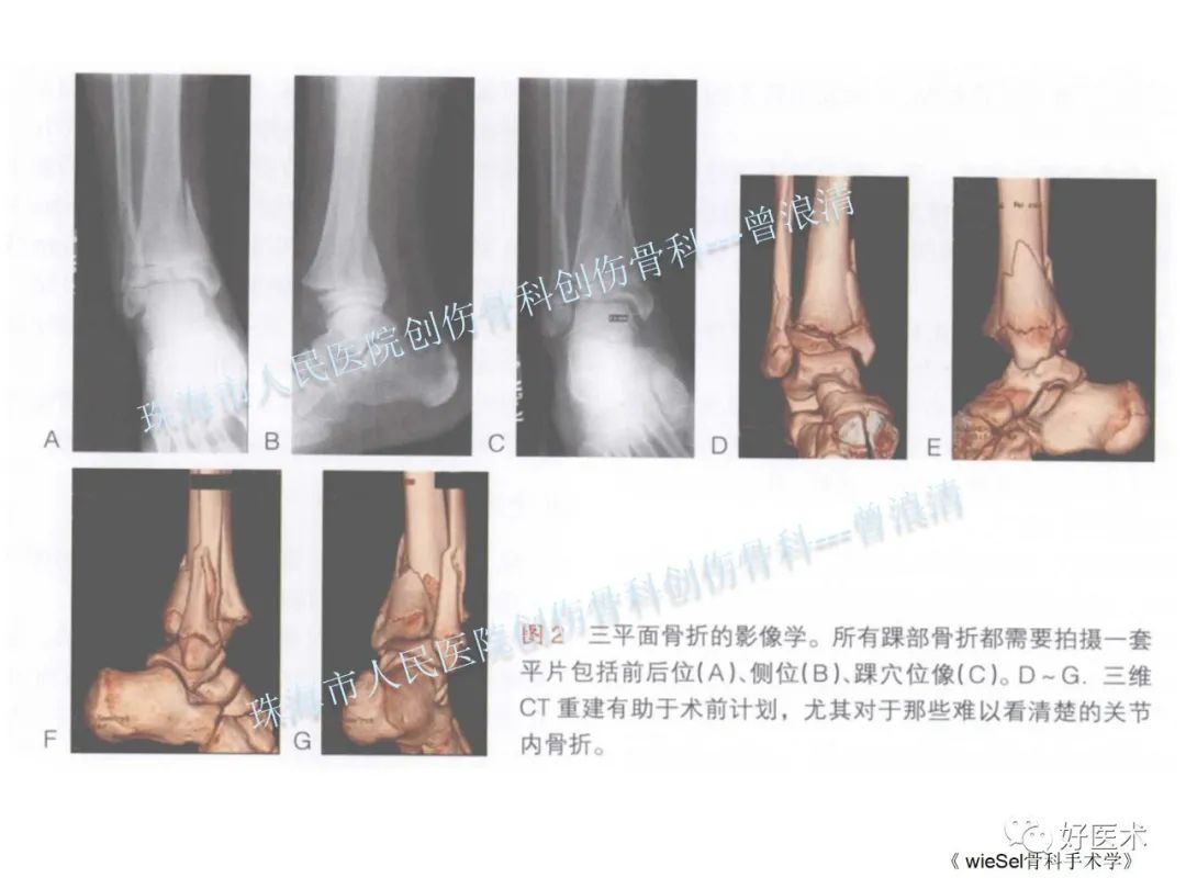 纯高清图谱讲解儿童踝关节骨折，99%的人都能看懂！