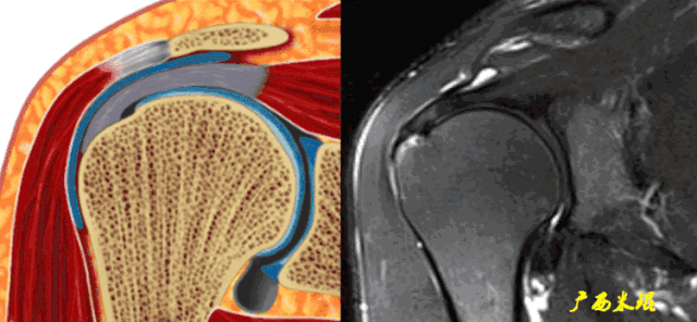 图解教程：超高清GIF图解肩袖损伤MRI诊断，推荐收藏！
