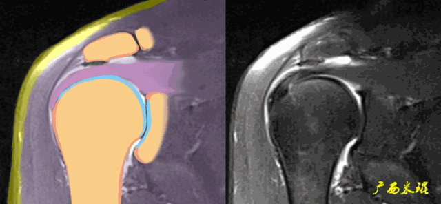 图解教程：超高清GIF图解肩袖损伤MRI诊断，推荐收藏！