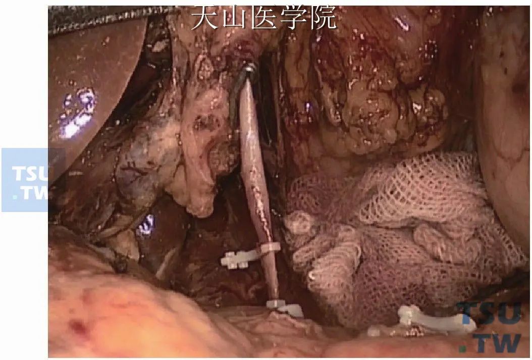 看图说话：腹腔镜远端胃大部切除术详解